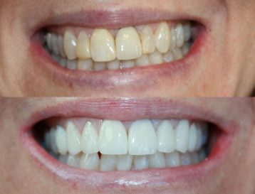 Dental Crowns