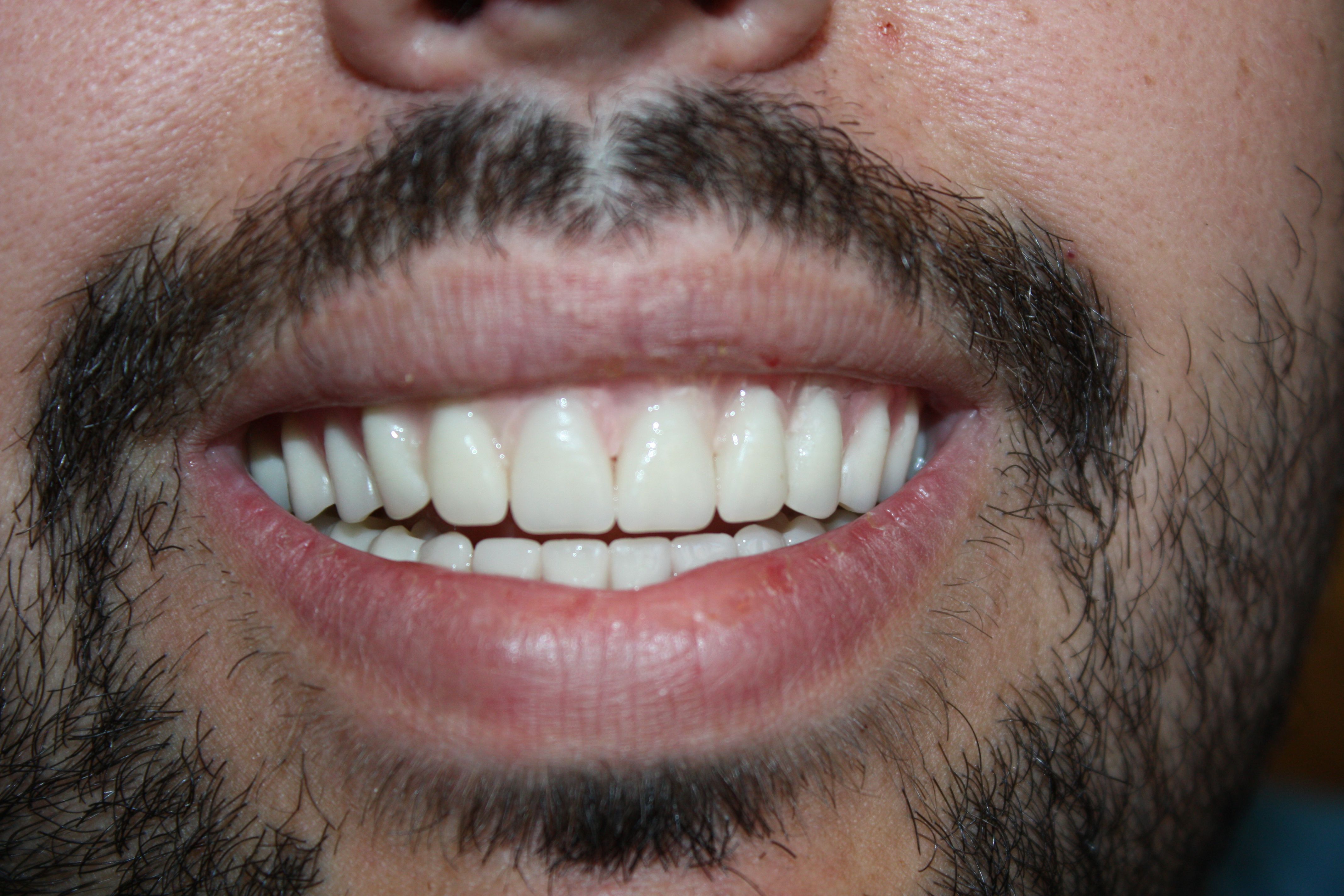Upper & Lower Snap In Denture | After