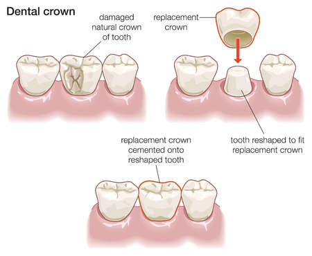 Crown Procedure