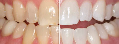 Teeth Before and After