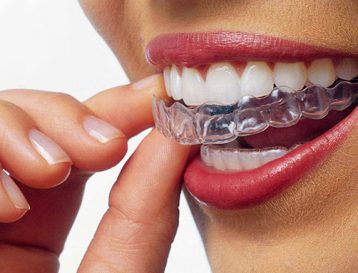 Invisalign