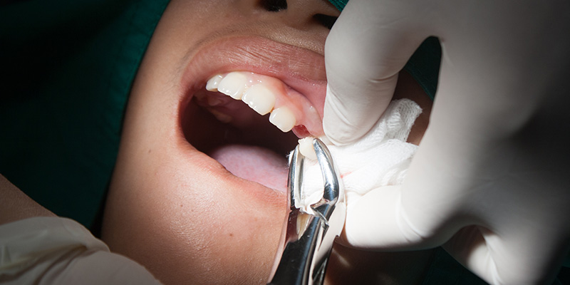 Tooth Extractions at Otero Family, Cosmetic & Implant Dentistry